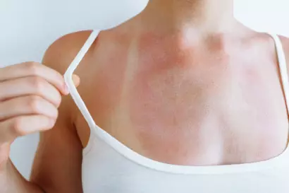 Protéger sa peau en été