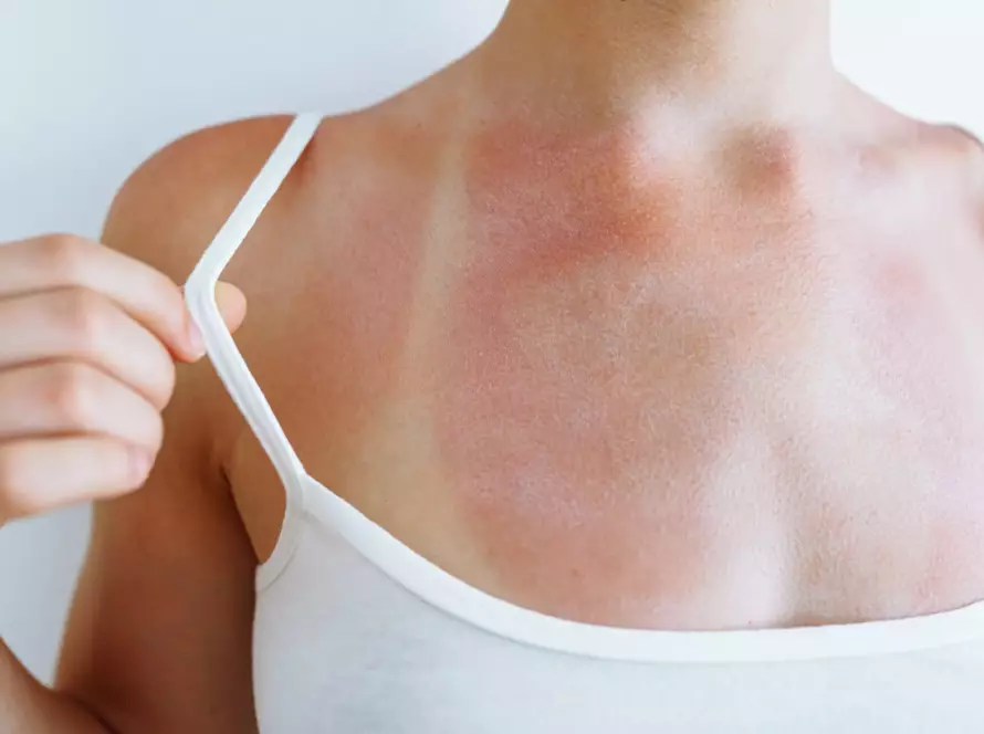 Protéger sa peau en été