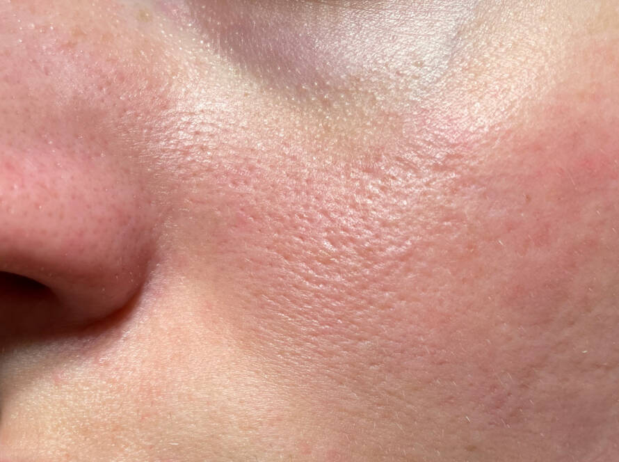 barrière cutanée endommagée