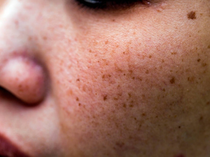 traitement taches cutanées clermont-ferrand