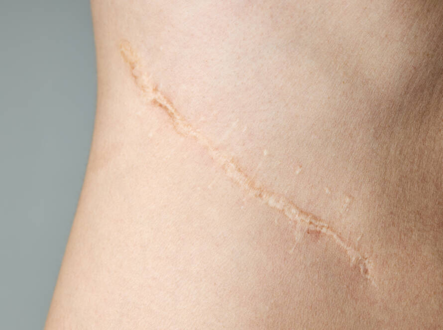 atténuer cicatrice blanche clermont-ferrand