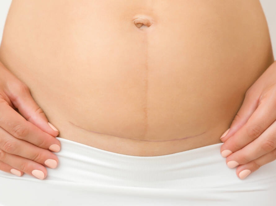 soin cicatrice post opératoire clermont-ferrand