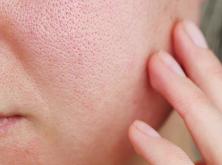 Pores dilatés Clermont-Ferrand