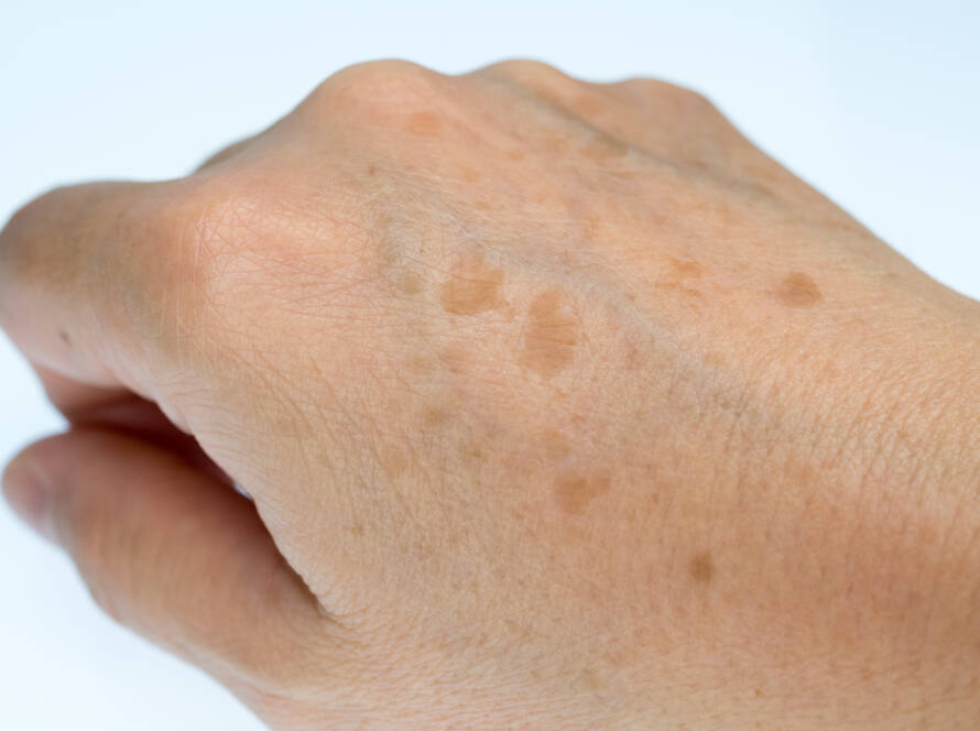 Rajeunissement mains Clermont-Ferrand